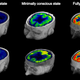 Glucose metabolism in the brain in patients with chronic disorders of unconsciousness. (Image: Stender et al., 2016)